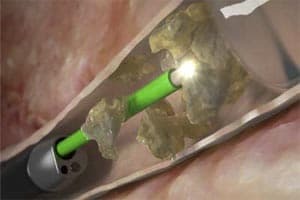 Litotripsia a laser