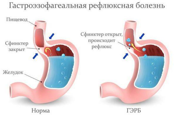 Gastroezofagealna refluksna bolezen( GERD)