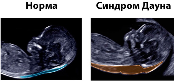 Amniocenteza tijekom trudnoće. Što je to, točnost rezultata, koliko dugo to rade, posljedice, kontraindikacije