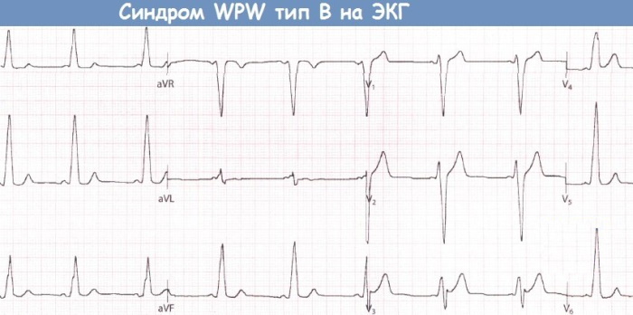 WPW (WPW) EKG -syndrom. Tegn på at det er