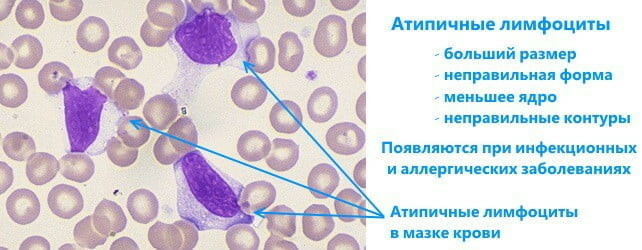Atipikus limfociták a gyermek vérvizsgálatában. Mit jelent