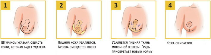 Povešene prsi: kako zategniti, preprečiti povešanje prsi pri ženskah
