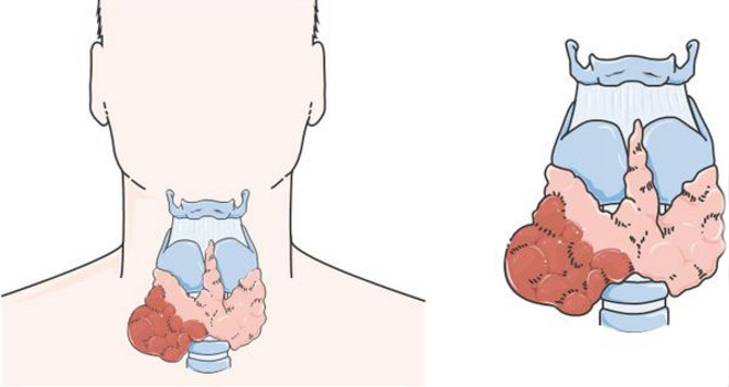 Follicular tumor of the thyroid gland