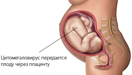 Cytomegalovirus IgG positive. What does this mean in the analysis of a child, women, treatment