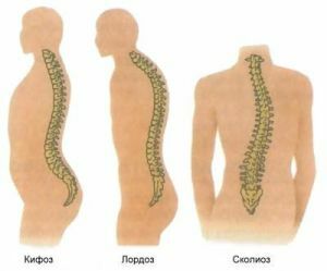 Tipos de curvatura patológica da coluna vertebral