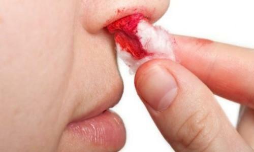 Krvar nosa krvi u odrasloj osobi: uzroci