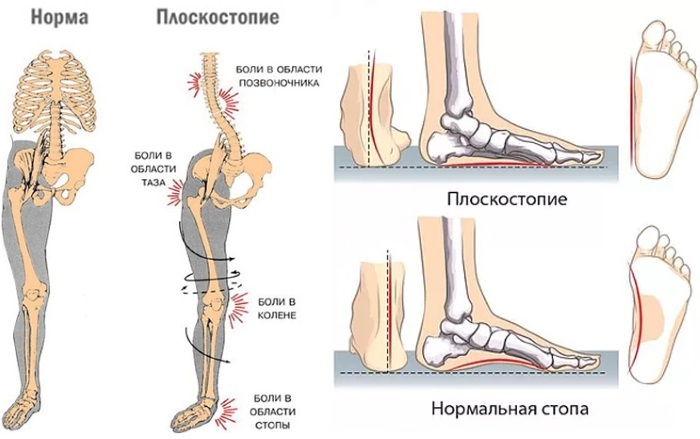 רגליים שטוחות. סימפטומים אצל מבוגרים, תארים, אופן הקביעה, טיפול