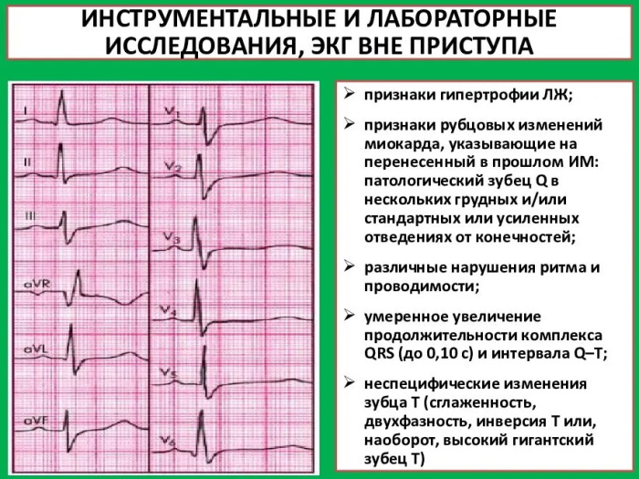 Cicatricial changes in the myocardium on the ECG