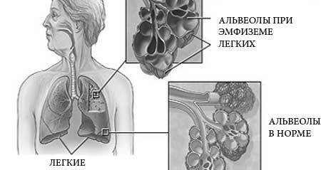 Symptoms of emphysema