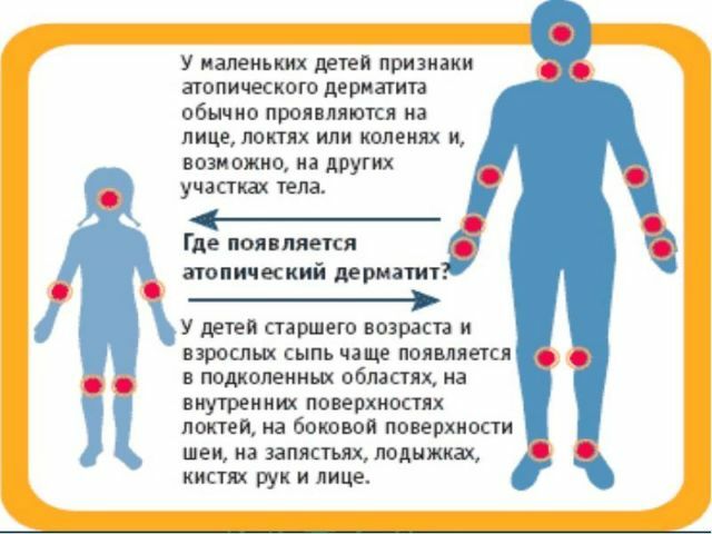 Symptoms of atopic dermatitis