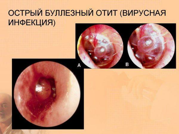 Ostre pęcherzowe zapalenie ucha środkowego