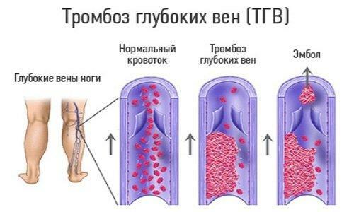 Mélyvénás trombózis