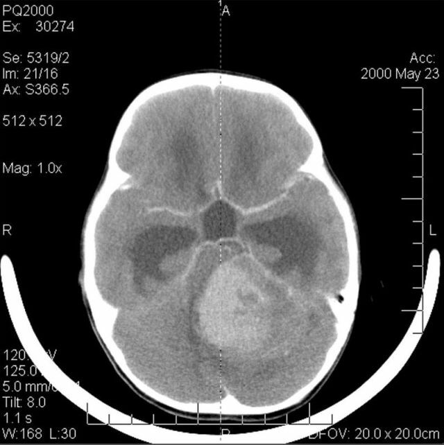 MRI nádoru v mozgu