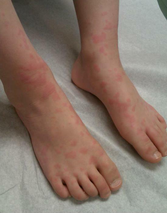 Minyak atsiri dapat menyebabkan reaksi alergi, dalam hal ini, pengobatan harus dihentikan