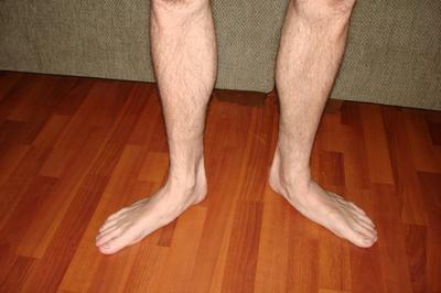 Aux raisons qui contribuent au développement des déformations des pieds, la prédisposition héréditaire