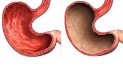 Lymphofollikular hyperplasia of the gastric mucosa: what is it?