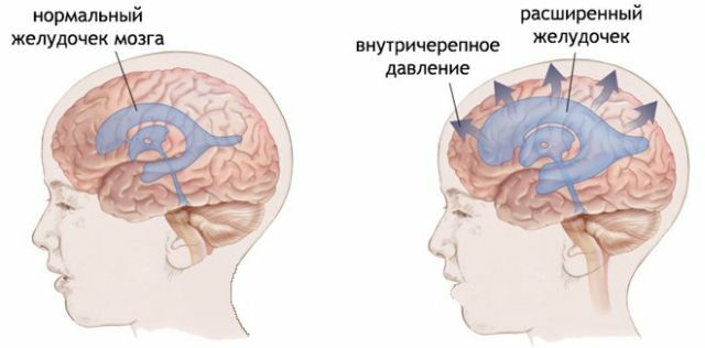 Intracranial hypertension: symptoms and treatment in adults and children