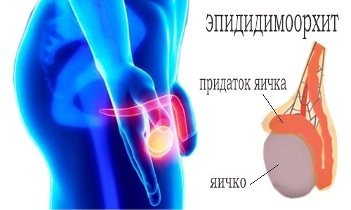 Effective treatment of inflammation of the testicles and their appendages