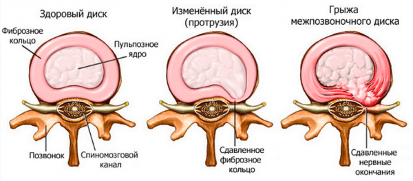İntervertebral disklerde meydana gelen değişiklikler