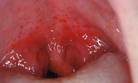 Foto da garganta com dor na boca herpetica