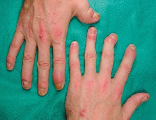 Psoriazinis artritas. Rentgeno požymiai, gydymo metodai, kas gydo, klinikinės gairės