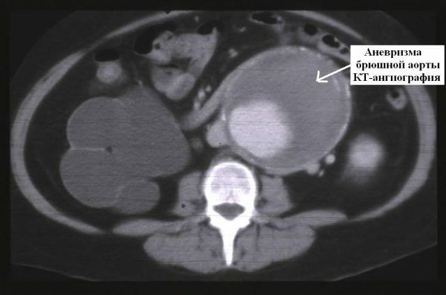 Aneuryzma aorty brušnej dutiny: typy, príčiny, symptómy, diagnóza, liečba chirurgickým zákrokom, ľudové prostriedky, prevencia + fotografie