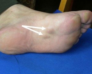contracția degetelor de la picioare