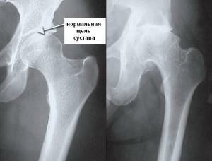 Osteoartrite da articulação do quadril no raio-x