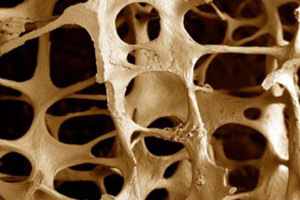 diffuse osteoporose van de wervelkolom
