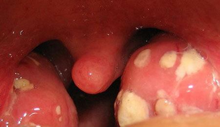 Purulent formations in the throat, photo