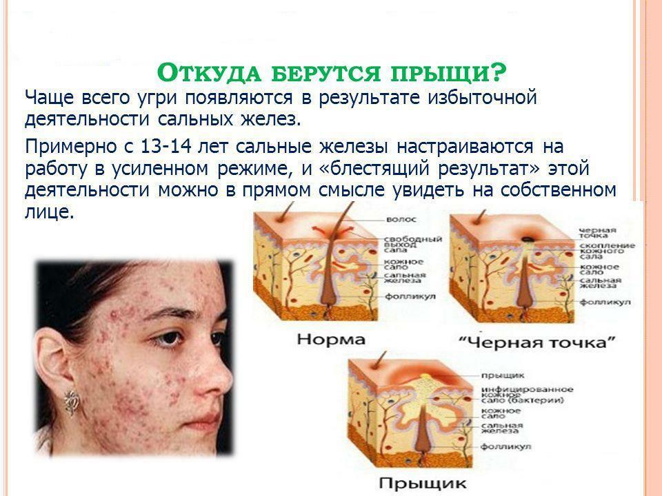 Årsager til acne