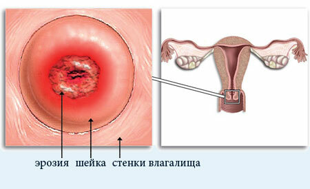 Cervical erózió - mi ez? Kezelés, tünetek és az erózió okai