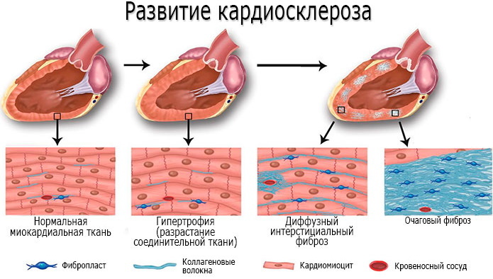 Cicatricialiniai miokardo pokyčiai EKG