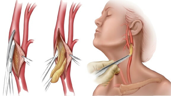 Nesenozinė BCA (brachiocefalinių arterijų) aterosklerozė