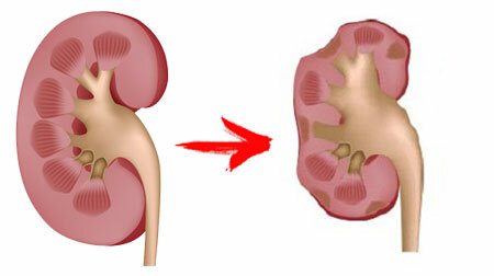 Symptoms of kidney failure in women