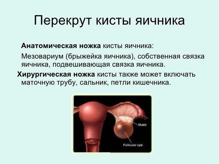 Torsion of ovarian cysts