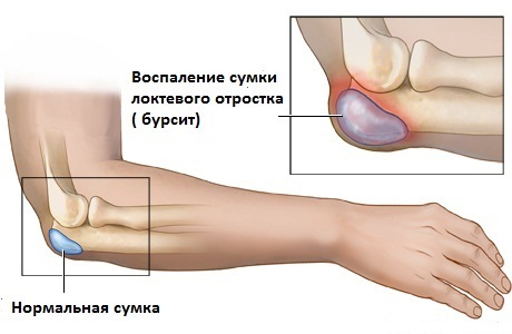 Bursitis lijevog zgloba: uzroci, simptomi, dijagnoza i liječenje
