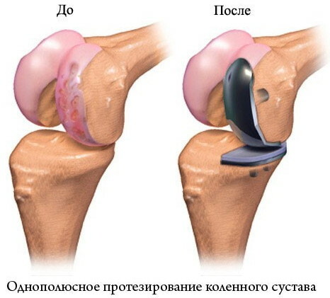 Arthroplastie du genou. Prix, réhabilitation
