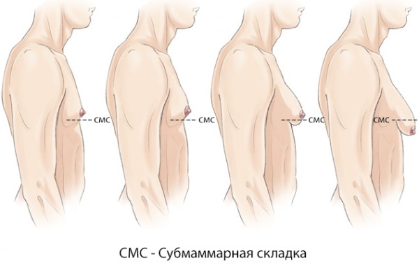 Surgery to remove gynecomastia in men. Price, is it complicated, how it goes, how long does it take