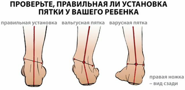 Cara mengenali kaki pengkor