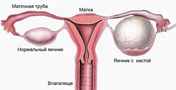 Chistul ovarian sparge: consecințele