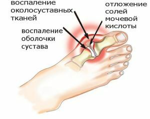 Foot Gout