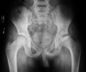 osteochondrose i hoftefugen på MR