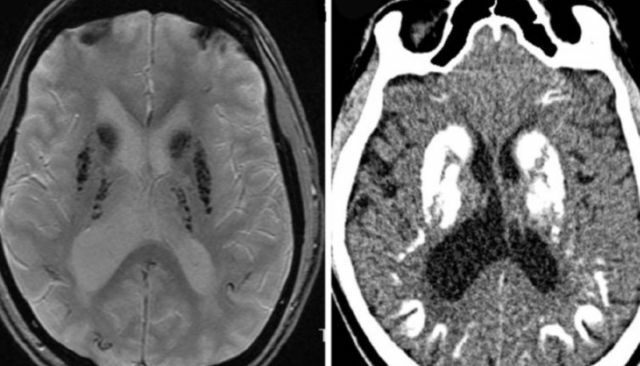 Fara-szindróma - a központi idegrendszer súlyos neurodegeneratív betegsége