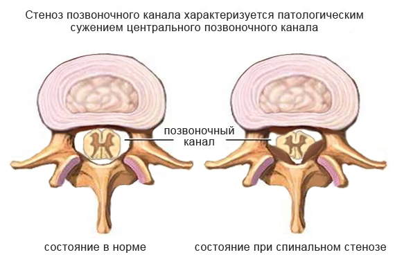Estenosis del canal espinal: causas, síntomas, tácticas de tratamiento