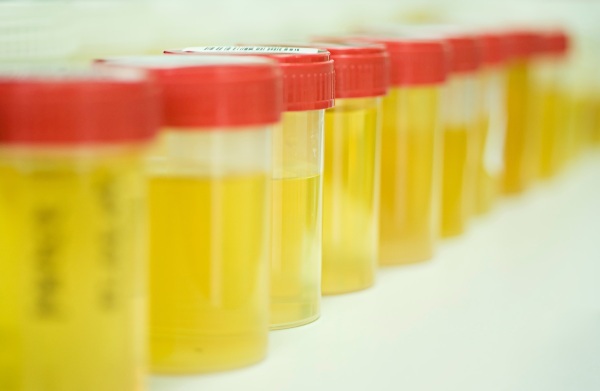 How to take a daily urine test, what does it show