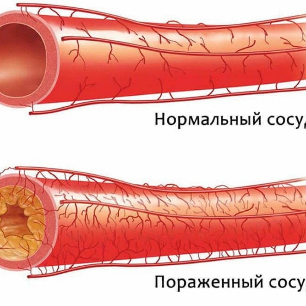 Vaskulær aterosklerose