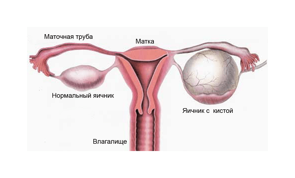 Représentation schématique du kyste ovarien