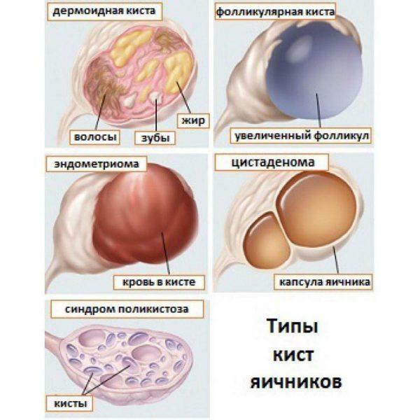 Typer av ovariecyster