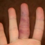 Az ujj sérülése